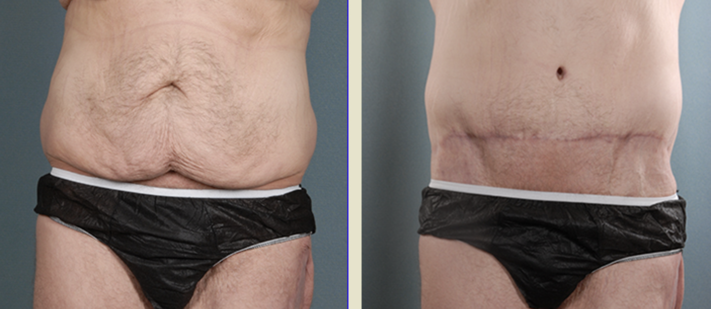 Abdominoplasty Before And After What You Need To Know Bellezie