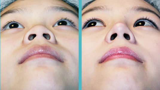 Reduction of too large nose for face
