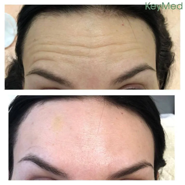 Botox before and after results
