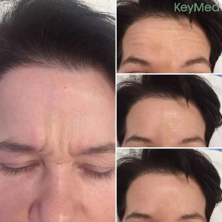 Botox before and after results
