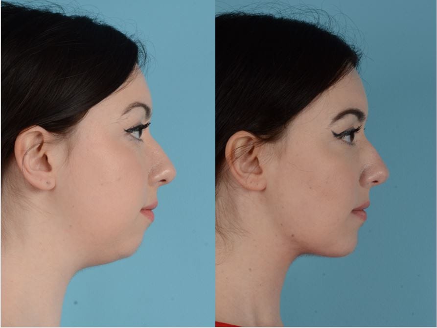 Buccal fat removal
