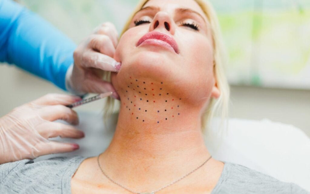 Double chin surgery or Kybella
