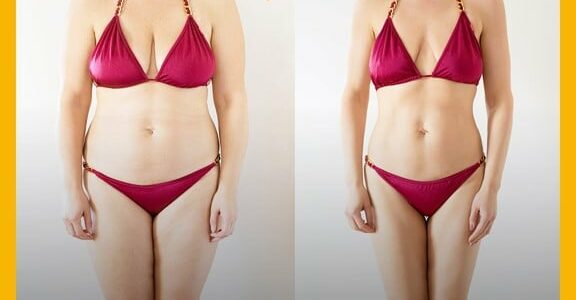 Effectiveness of liposuction

