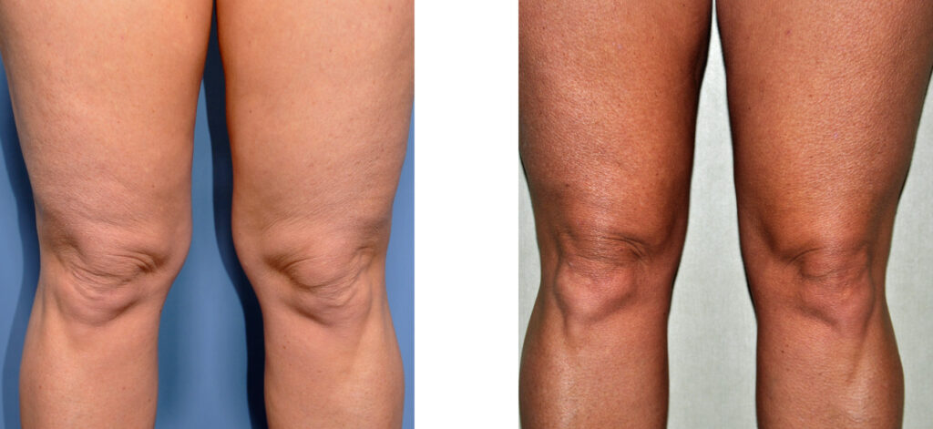 Removal of knee fat
