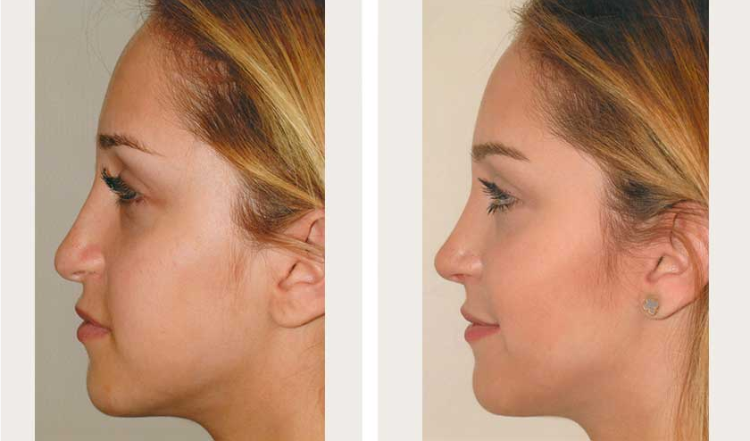 Revise poor nose job results
