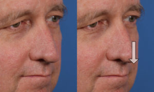 Correct nasal tip asymmetry
