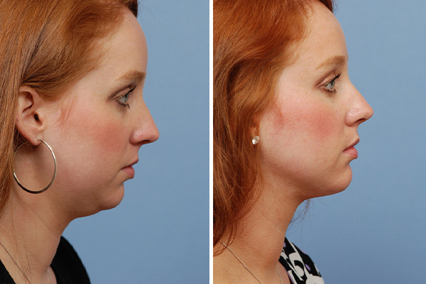 Double chin liposuction