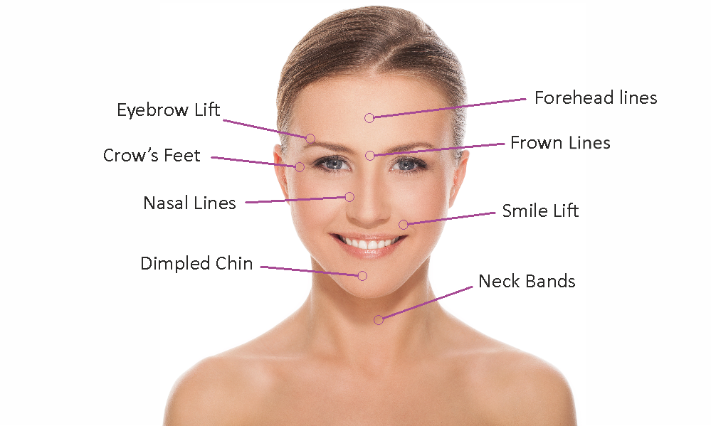 Treatment zones with botulinum toxin injections
