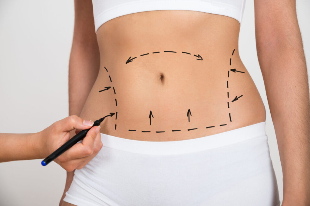 What is liposuction