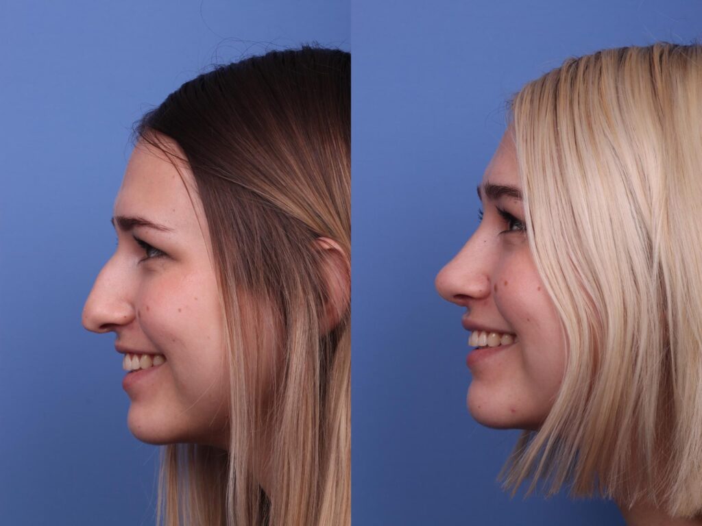 Revise poor nose job results
