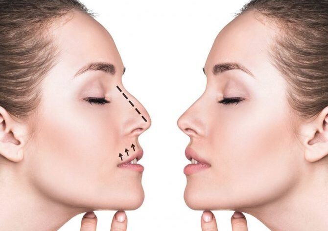 Effectiveness and types of rhinoplasty
