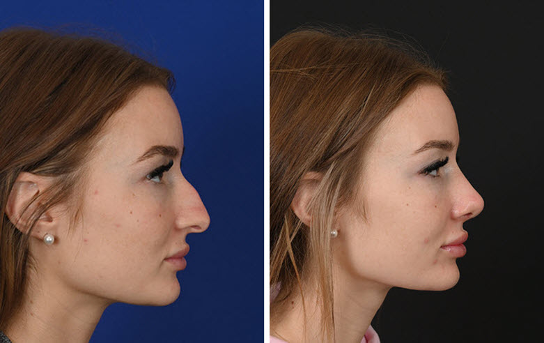 nose-shaping-types