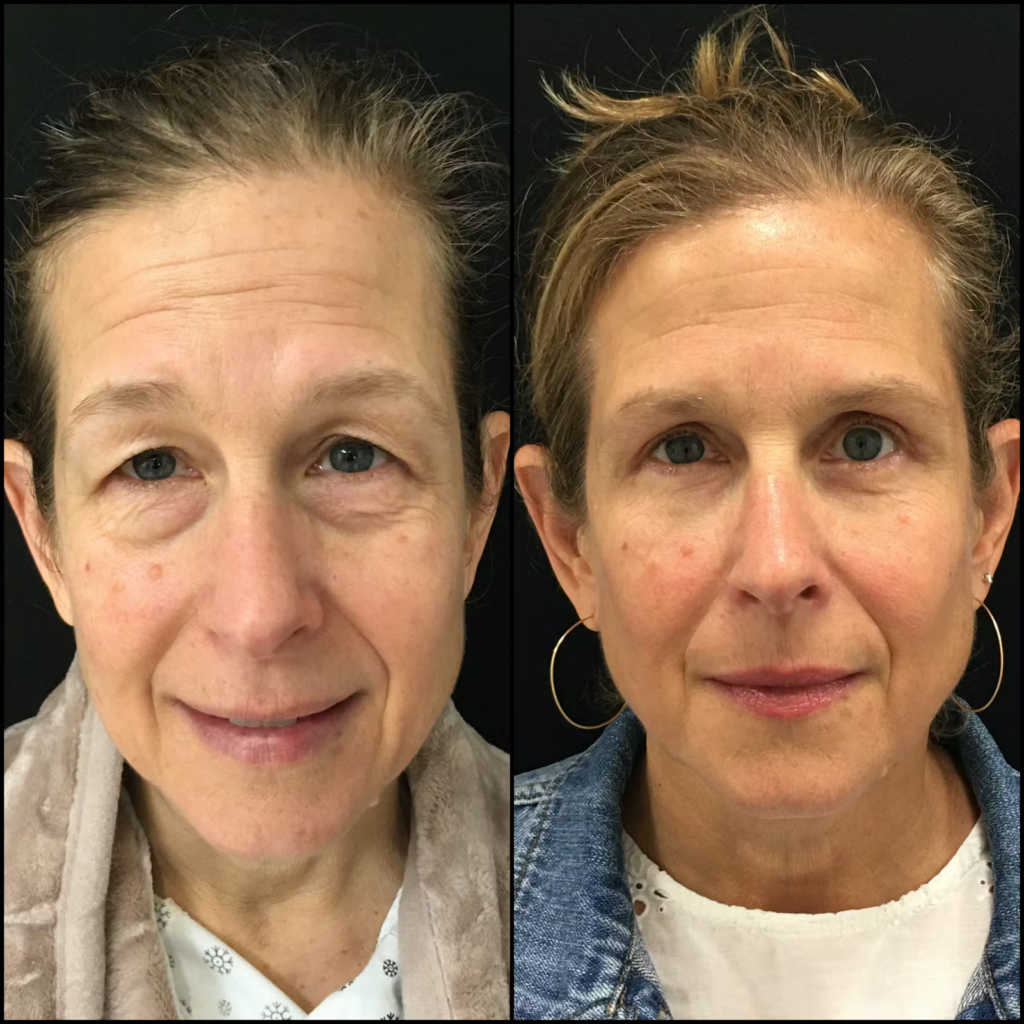 Before and after results of upper and lower blepharoplasty after month of recovery

