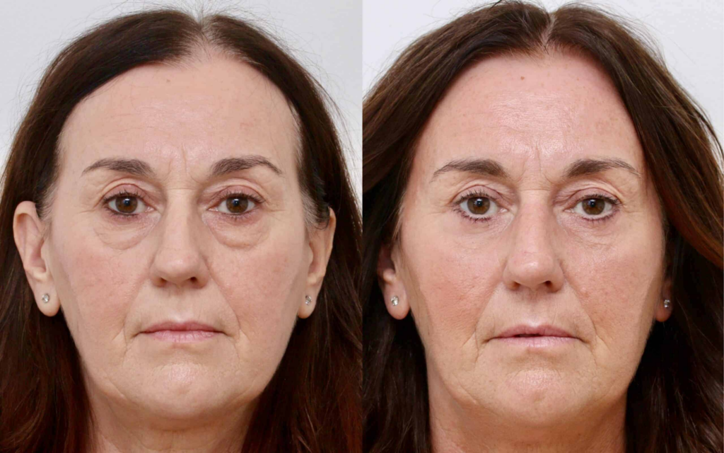Results you can achieve with lower blepharoplasty after 34-day recovery
