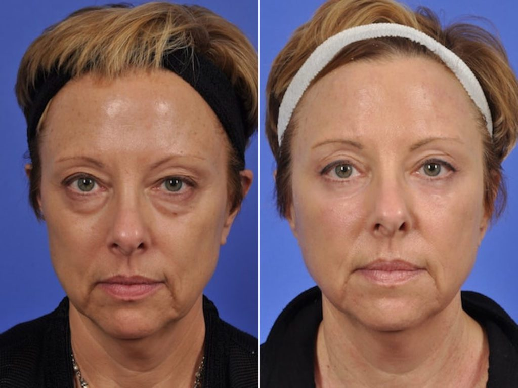Anti-aging results after upper and lower blepharoplasty after 2 months
