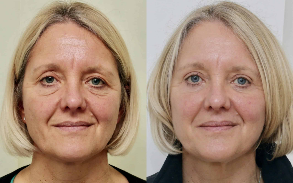 Insane eyes look improvement after 40-day upper and lower blepharoplasty recovery
