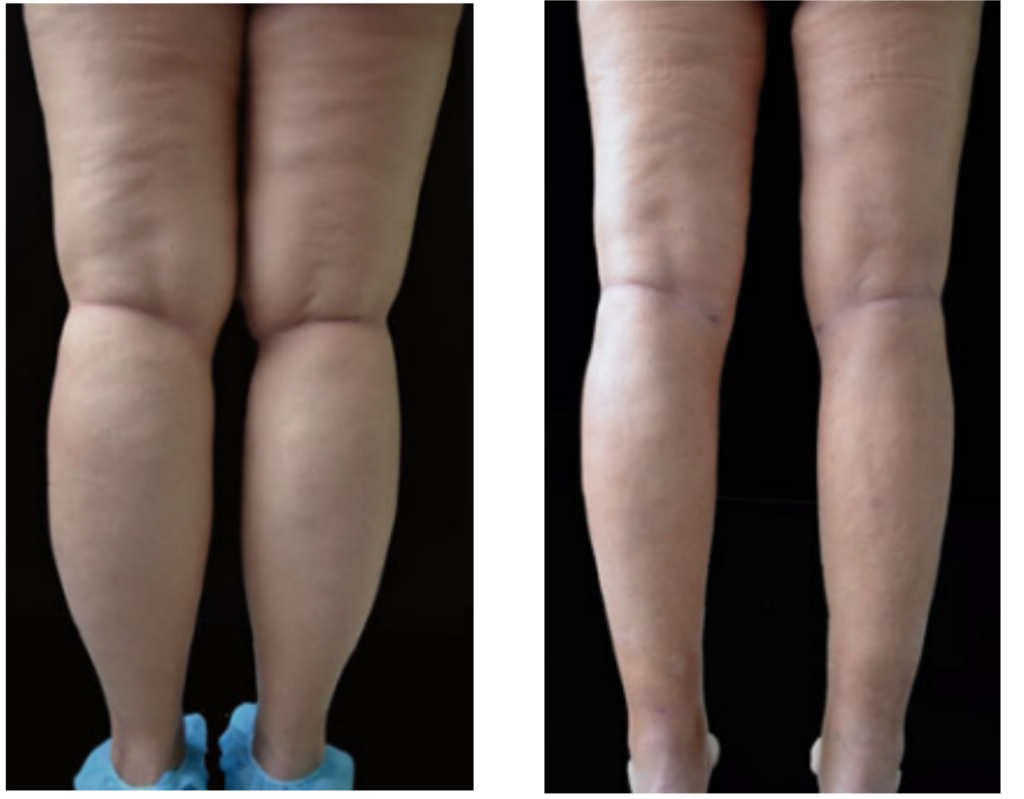 Lipo HD on legs before and after