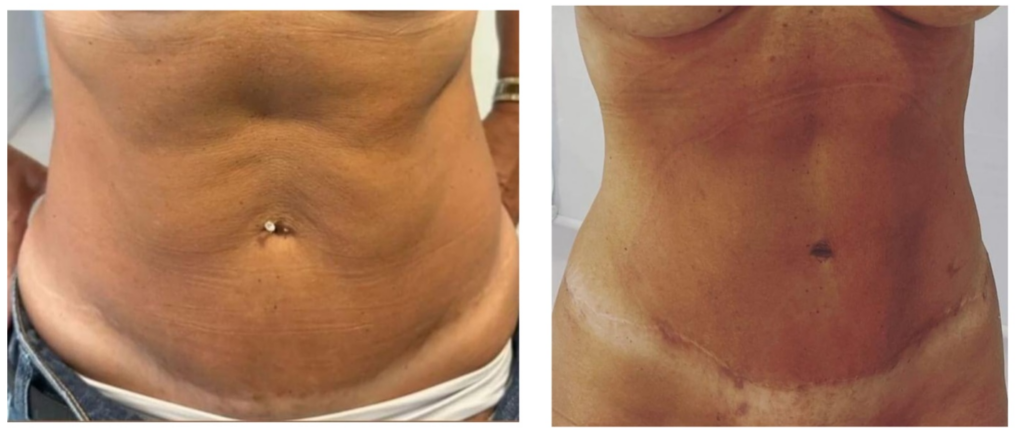 Lipo HD on the stomach before and after