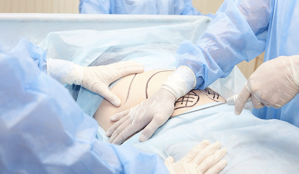 How is Liposuction HD Performed

