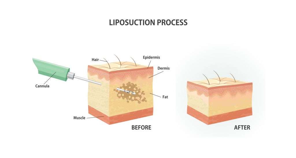 Liposuction process
