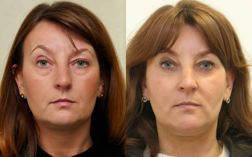 Stupendous anti-aging effect after the 28-day blepharoplasty recovery
