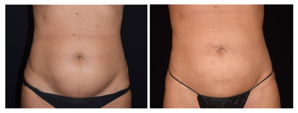 Lipo HD on the stomach before and after
