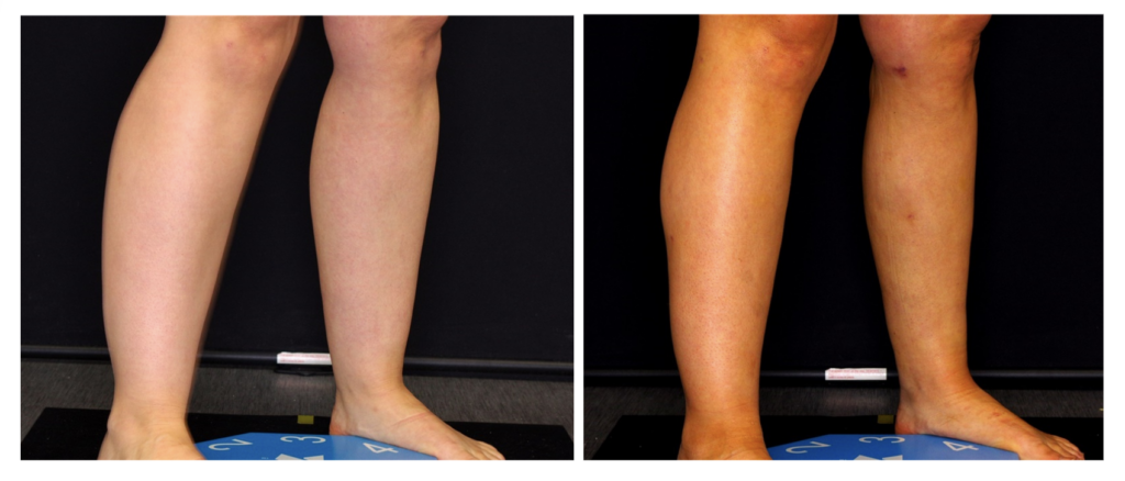 Lipo HD on legs before and after
