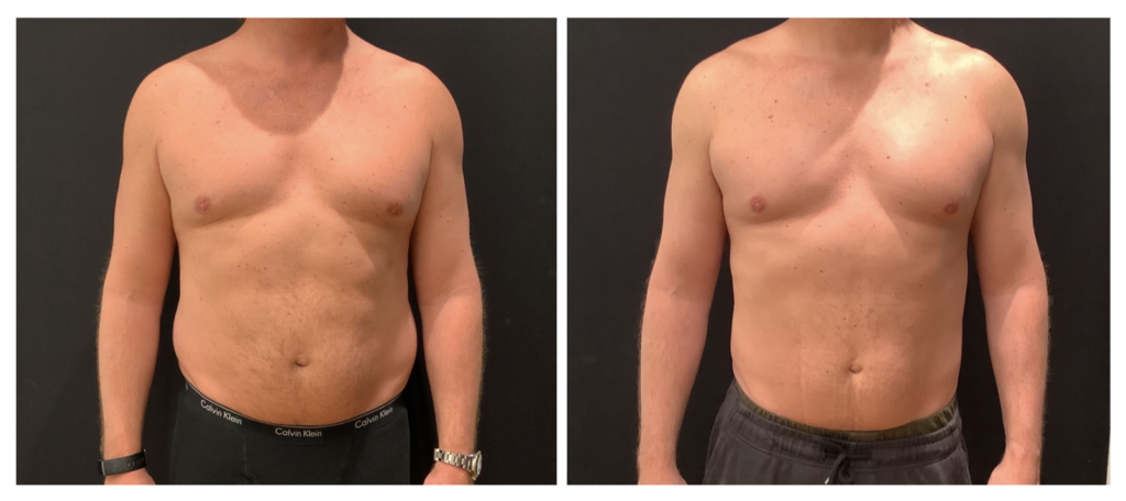 Lipo HD on the stomach before and after
