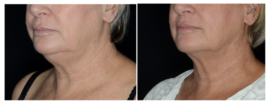 Lipo HD on the neck before and after
