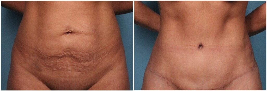 The result of mini abdominoplasty: before and after
