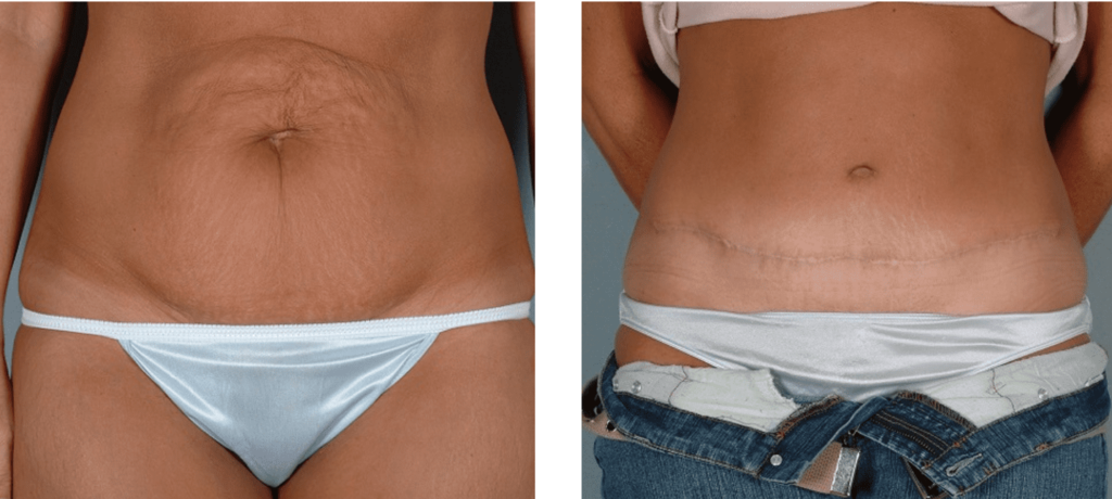 Abdominoplasty before and after: scar
