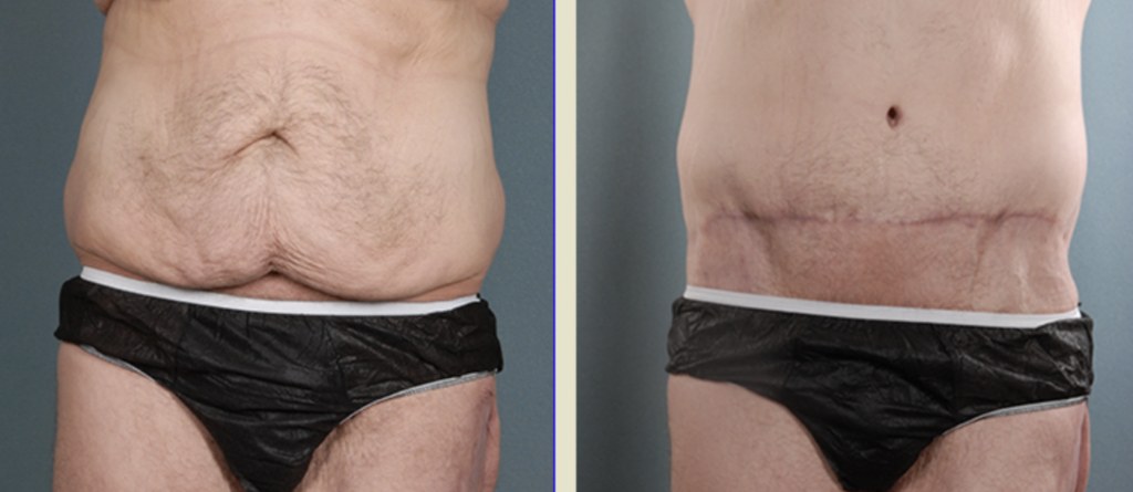 The result of abdominoplasty with lipo after weight change: before and after
