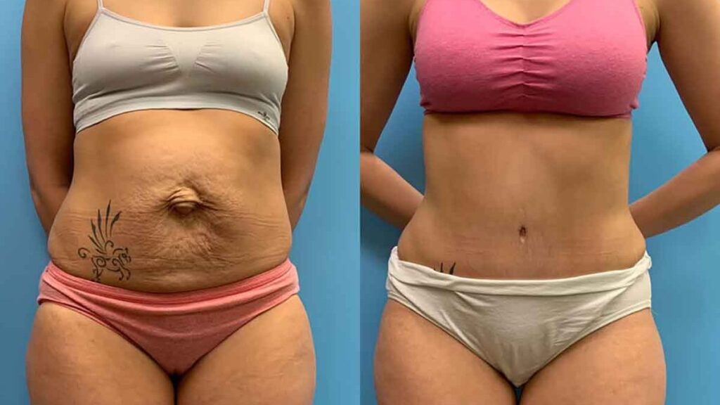 The result of abdominoplasty after pregnancy: before and after
