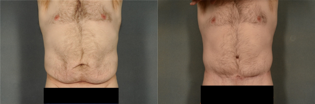 As we said, abdominoplasty with or without lipo can be performed on the male body as well.
