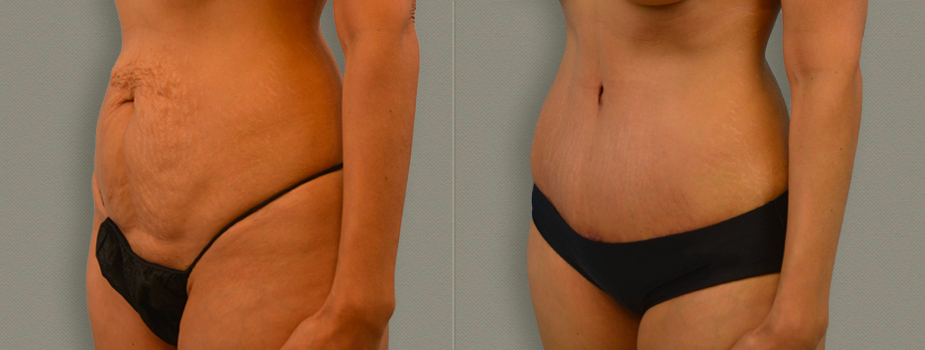 The result of abdominoplasty after weight change: before and after
