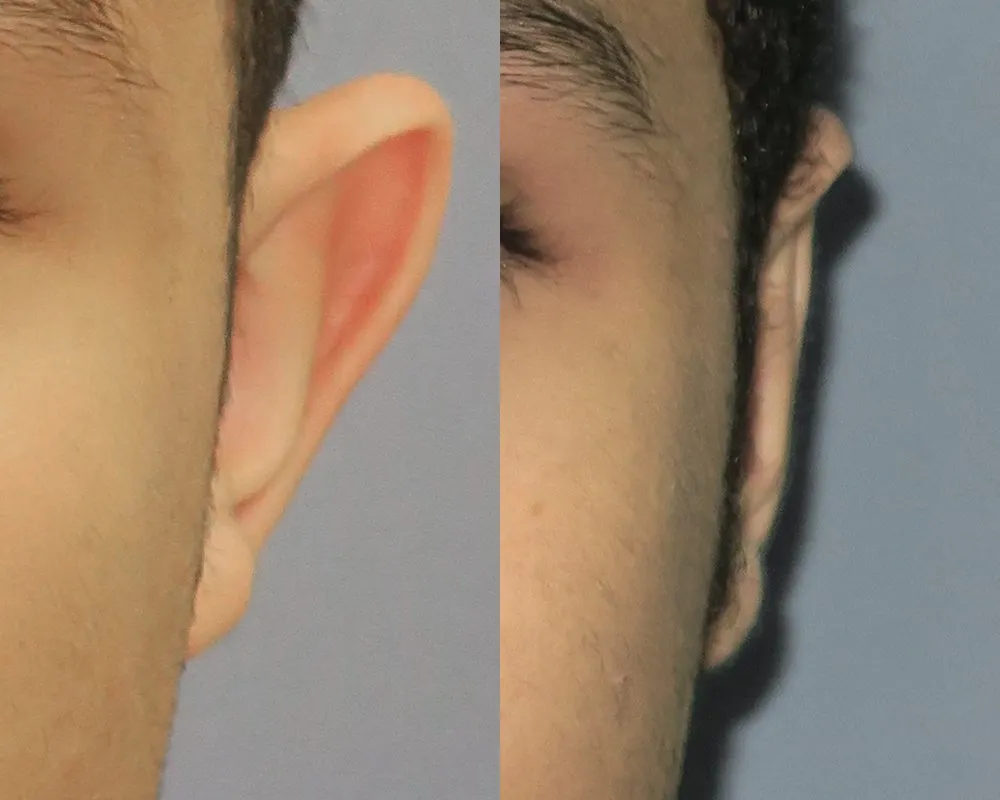 Protrudent ear before and after

