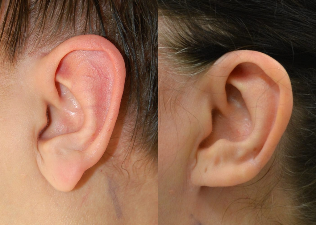 An example of otoplasty for macrotia
