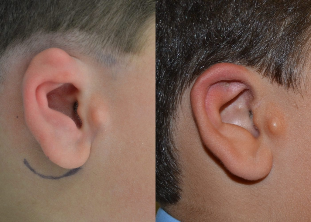 An example of otoplasty for constricted ears
