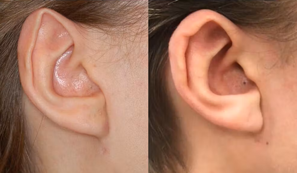 An example of otoplasty for Stahl’s ears
