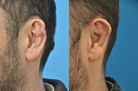 An example of otoplasty for cauliflower ears
