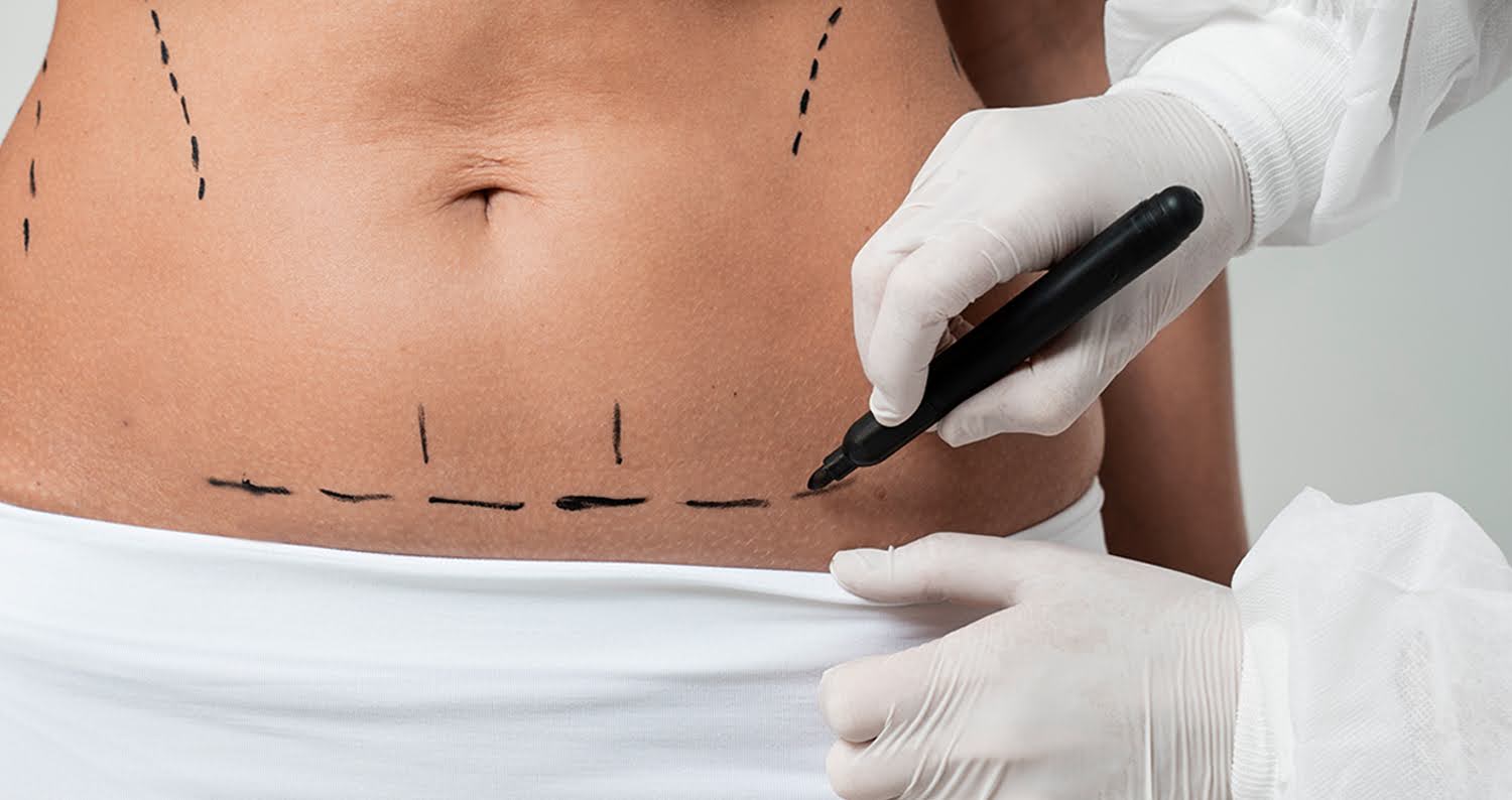 Doctor Explains What Abdominoplasty Recovery Feels Like - Bellezie