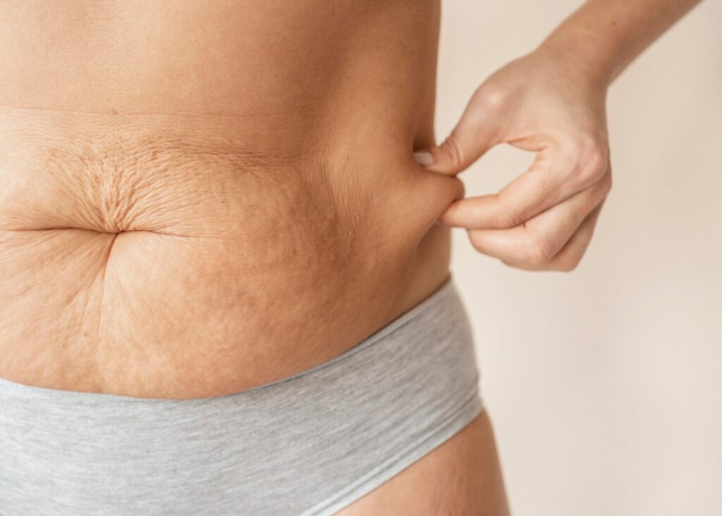 Abdominoplasty Recovery Complications
