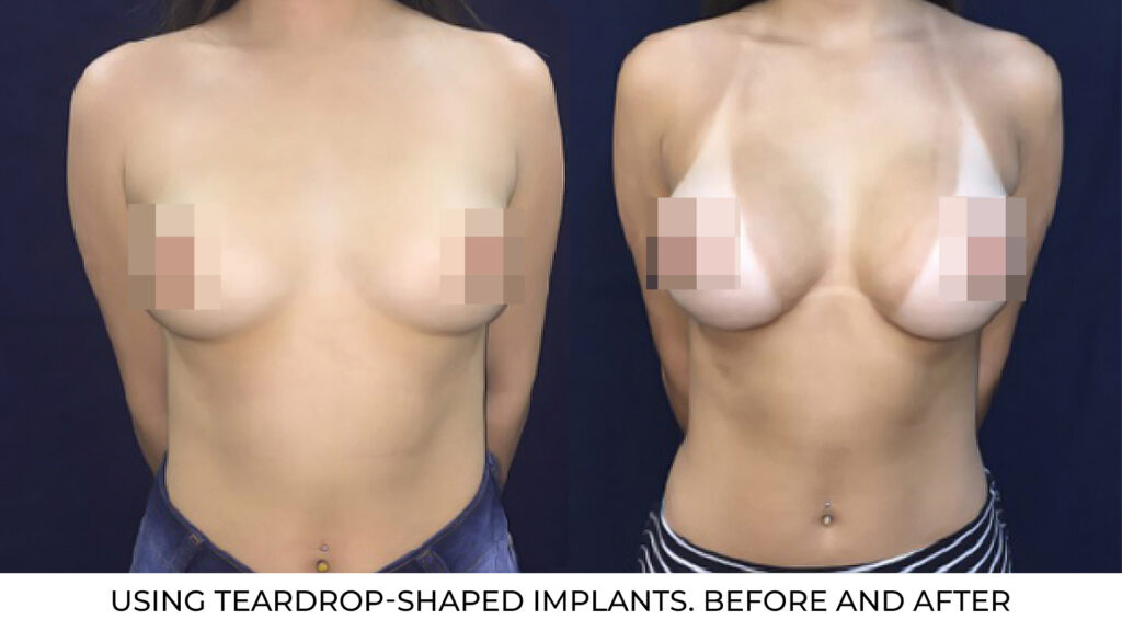 Breast augmentation using teardrop-shaped implants