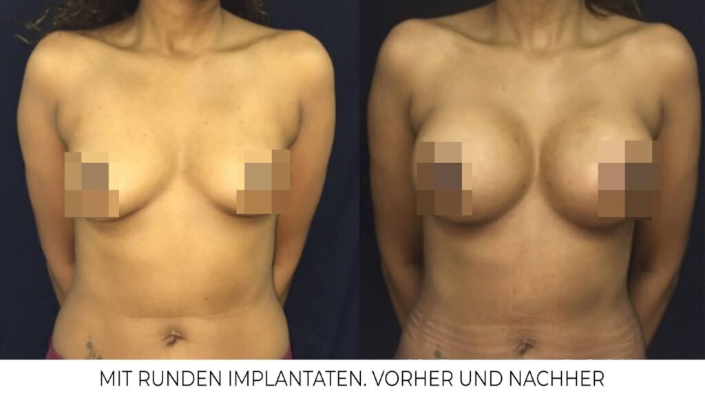 Brustvergrößerung mit rund geformten Implantaten [4]
