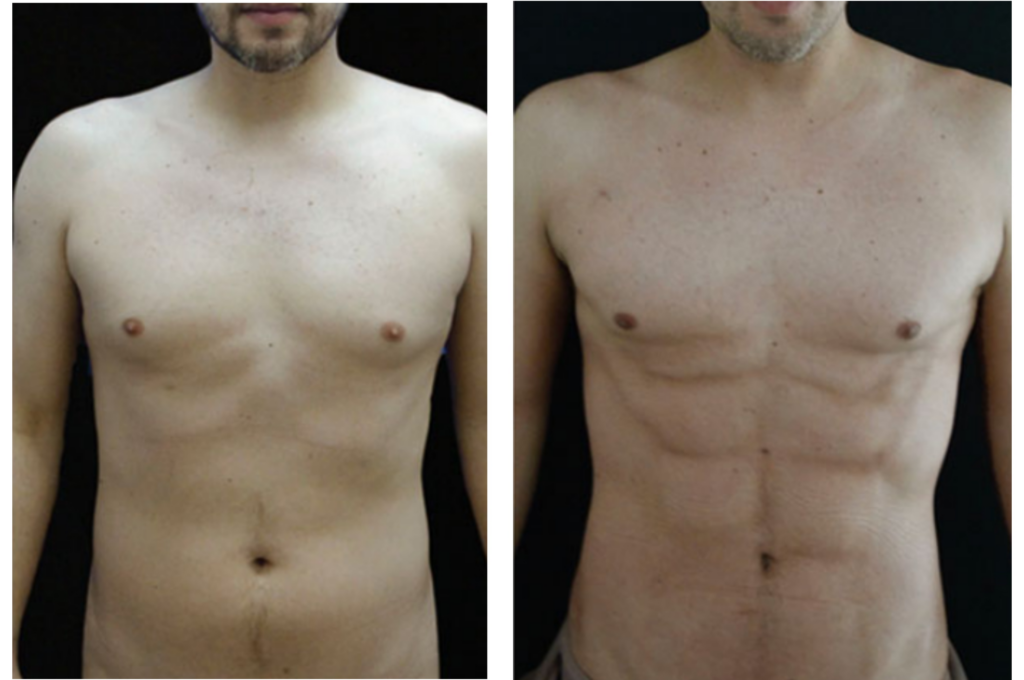 Lipo-HD-on-the-stomach-before-and-after