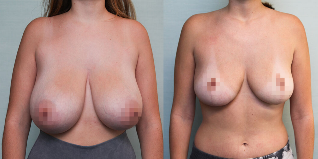 mamoplastic reduction